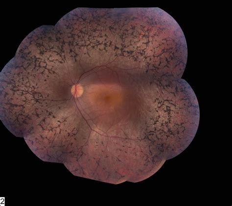 retinitis pigmentosa ehliyet